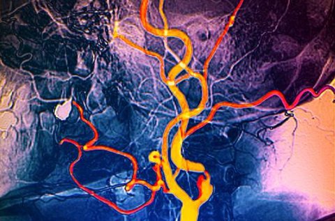 Nyaki erek color Doppler ultrahang vizsgálata