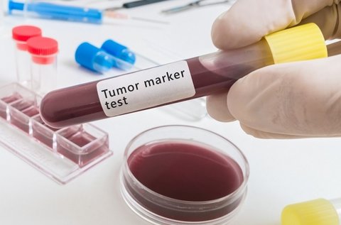 Teljes vérképvizsgálat tumormarker szűréssel