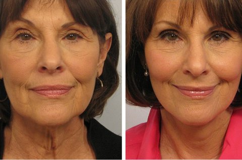 Azonnali bőrfiatalítás 3G HIFU 275 pontos kezeléssel