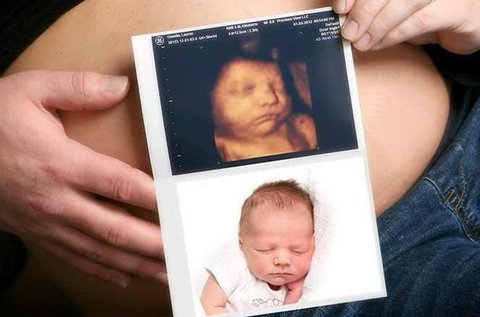 4D-s ultrahang készítése kisbabádról