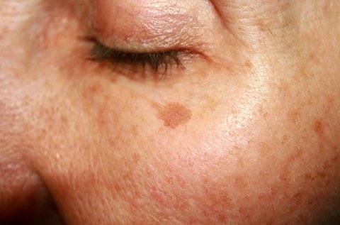 Mezopenes májfolt és öregségi folt elleni kezelés