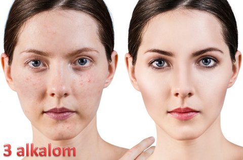 3 alkalmas pattanás kezelés E-light géppel