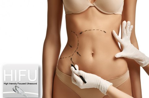 BodyArt HIFU hasfogyasztó és feszesítő kezelés