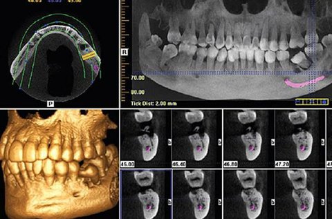 3D Cone Beam fogászati CT vizsgálat