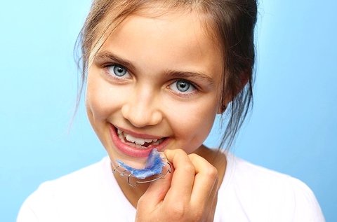 Kivehető fogszabályozó készülék 1 fogívre